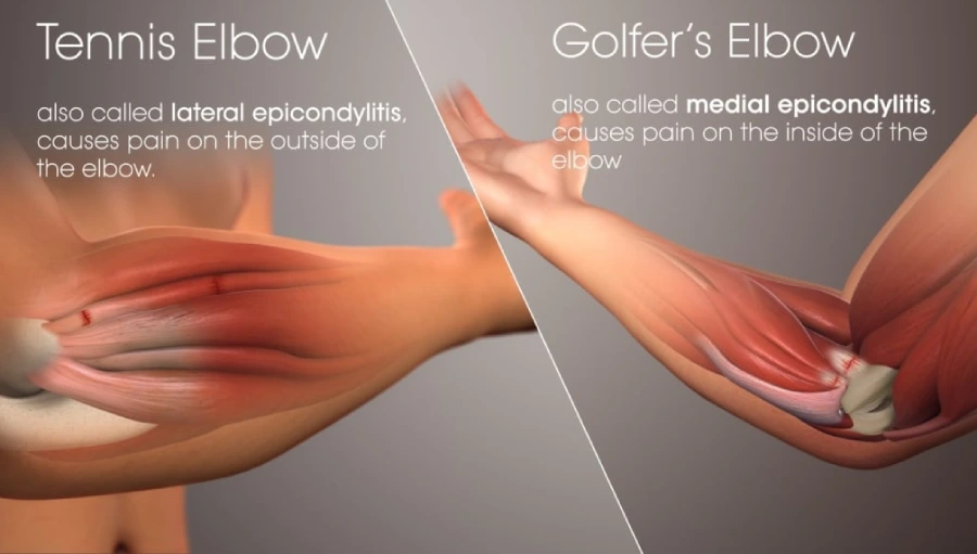 Illustration showing tennis elbow, golfer’s elbow and arthritis that arm sleeves can help