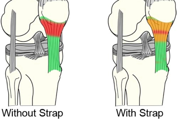 Knee strap, the difference near the kneecap between wearing and not wearing is shown
