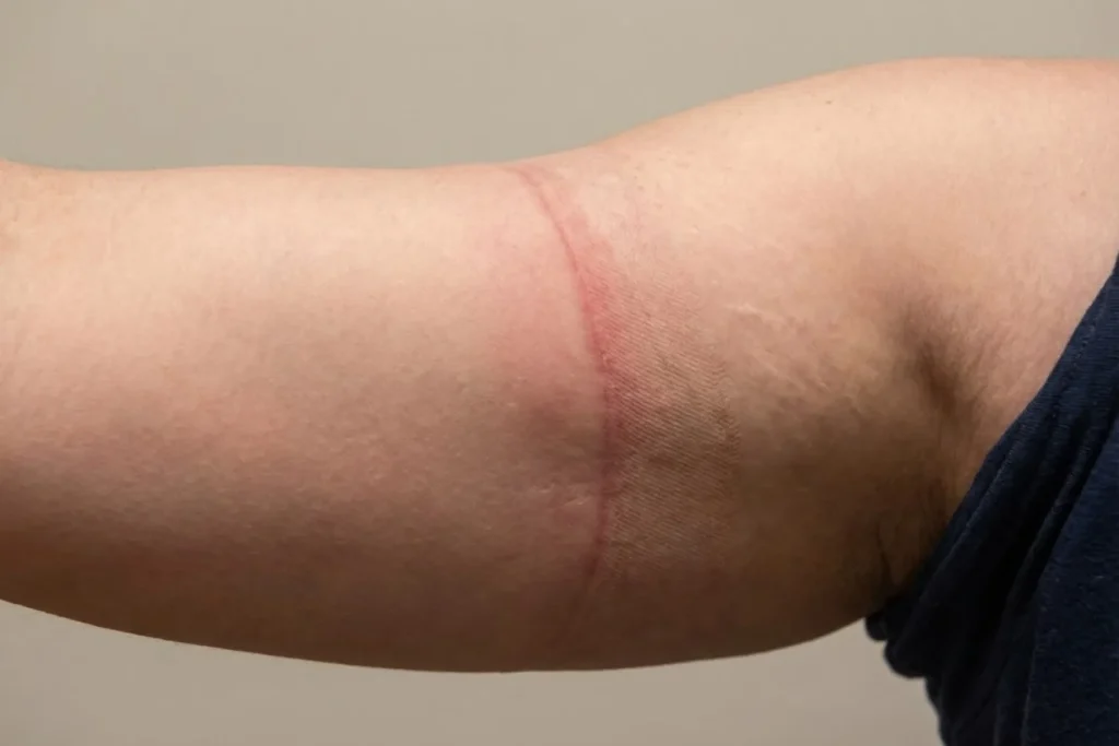 Red skin indentation mark on an upper arm caused by an overly tight compression sleeve