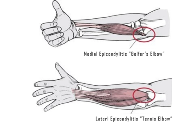 Tennis elbow and golfer's elbow illustration